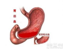 胃癌吃什么好,胃癌患者饮食调养指南